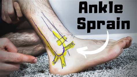 High Ankle Sprain Recovery Time The Best Treatment Guide