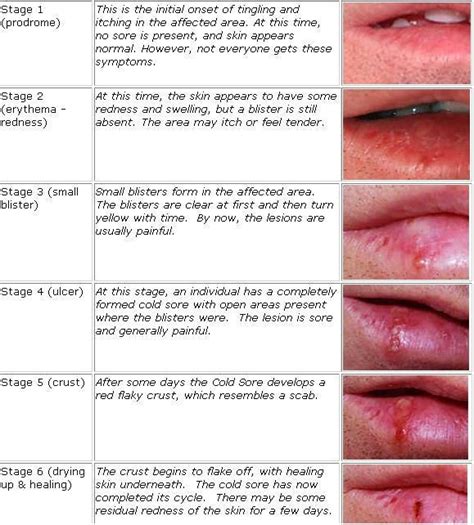 Carmex Cold Sore Treatment