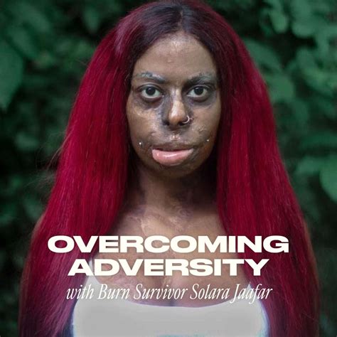 Overcoming Adversity with Burn Survivor Solara Jaafar | The Skinny