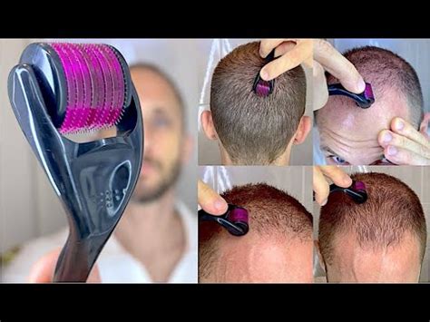 Como Usar O DermaRoller Minoxidil Aloxidil Tratamento De Calvice