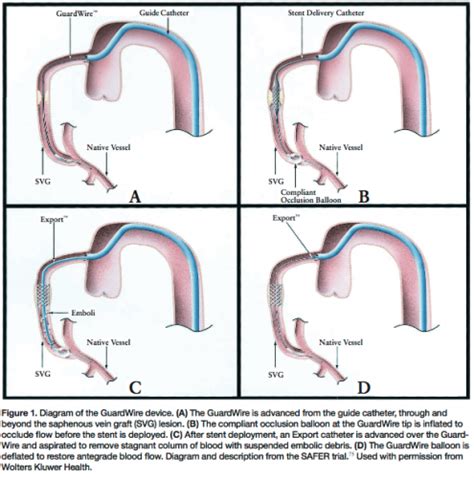 Saphenous Vein Graft Intervention: A Review