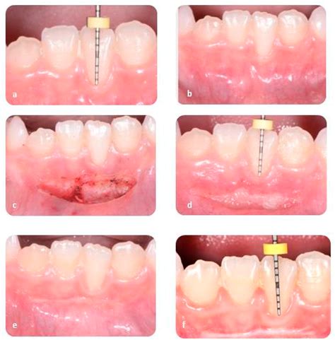 Labial Frenulum Laceration
