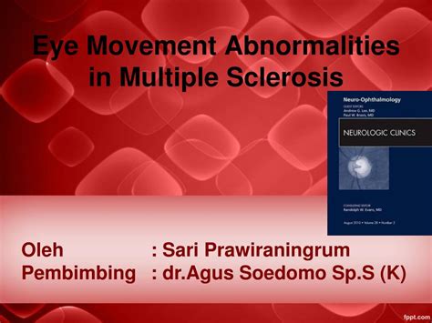 Ppt Eye Movement Abnormalities In Multiple Sclerosis Powerpoint