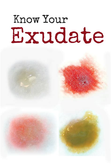 Exudate The Type And Amount Is Telling You Something Wound Care