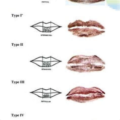 Pdf Cheiloscopy The Study Of Lip Prints In Sex Identification