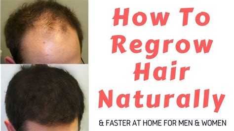 How To Regrow Hair Naturally And Faster Hair Loss Treatment For Men