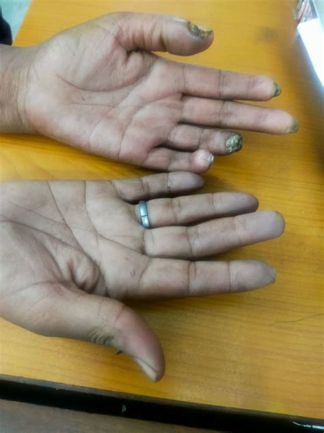 Gangrene Treatment by Dr. Kumar