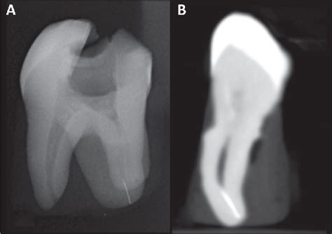 A A Radiographic Image Showing A Fractured File In The Db Root Canal