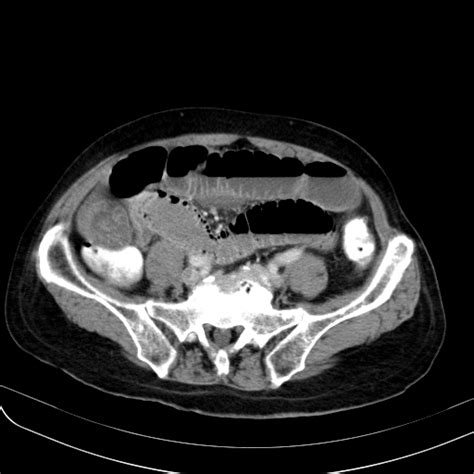 File Small Bowel Volvulus Causing Small Bowel Obstruction Mimicking