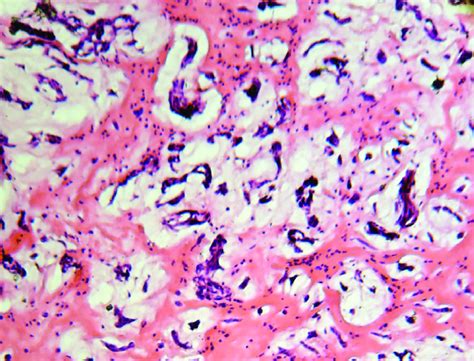 Single And Syncytial Cell Structures In Sporadic Heart Myxoma
