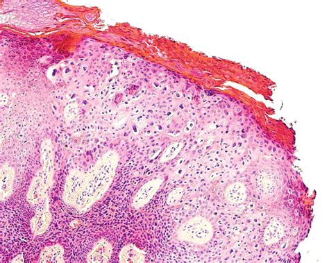 Intraepithelial Squamous Cell Carcinoma Of The Bowenoid Type With