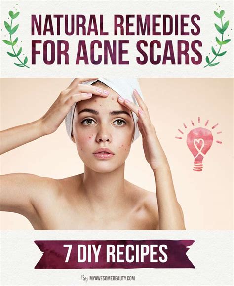 15 Natural Home Remedies To Get Rid Of Acne Scars Fast 53 Off