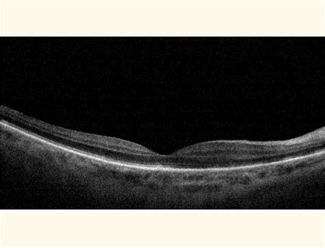 oct retina examination  injection