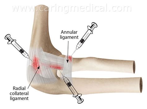 Lateral Epicondyle Injection
