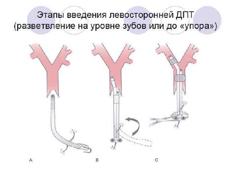 Однолегочная вентиляция в торакальной хирургии проблемы и решения