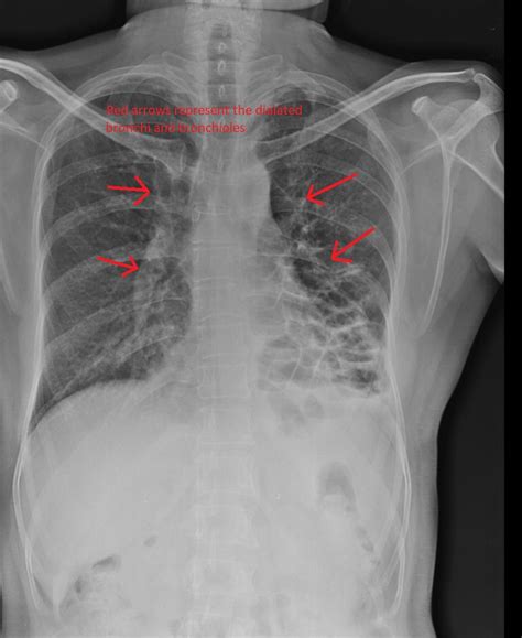 Bronchiectasis chest x ray - wikidoc