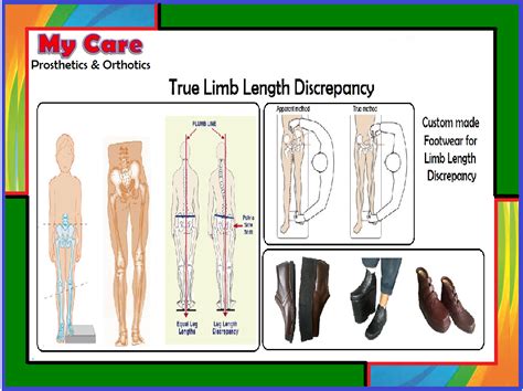 Limb Length Discrepancy Footwear Orthopedic Shoes At Rs 2500pair