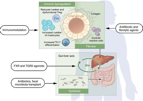 Figure 1 From Primary Sclerosing Cholangitis And The Path To