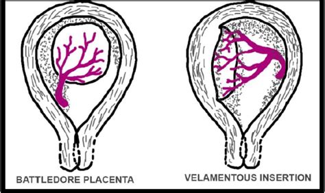 Battledore Placenta