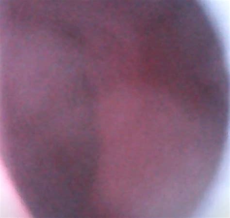 Colonoscopy After Anal Fvck ThisVid