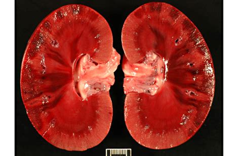 Pale Infarct Kidney