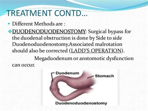 duodenal atresia