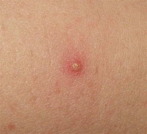 Folliculitis Causes Symptoms Diagnosis And Treatment Natural Health