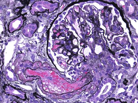 Ajkd Atlas Of Renal Pathology Calcineurin Inhibitor Nephrotoxicity