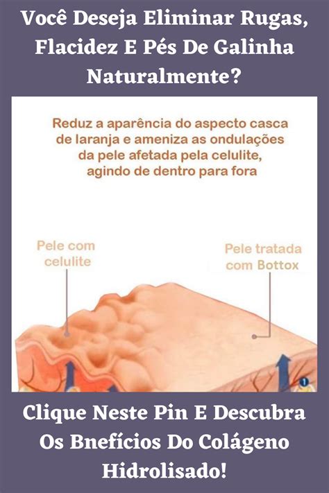 Elimine Flacidez Da Pele Rugas No Rosto E Trate Estrias Bottox