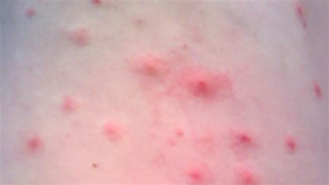 Topical Treatment For Hot Tub Folliculitis At Kerry Marlin Blog