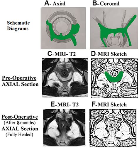 Anal Fistula Associated With Acute Abscess Ceg