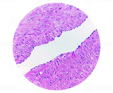 Photomicrograph, Prepatellar region histology showing Bursitis, acute