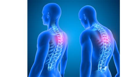 The Effects Of Misaligned Spine How To Manage It With A Singapore