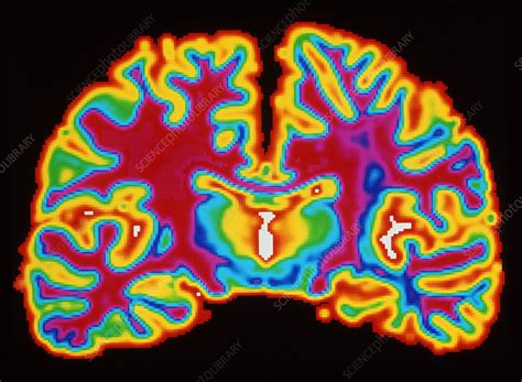 brain slice stock image p science photo library