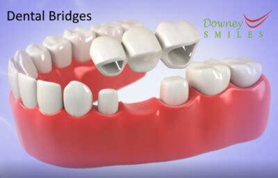 Dental Bridges: Types, Cost, Advantages, Procedure - Best Smiles Dental