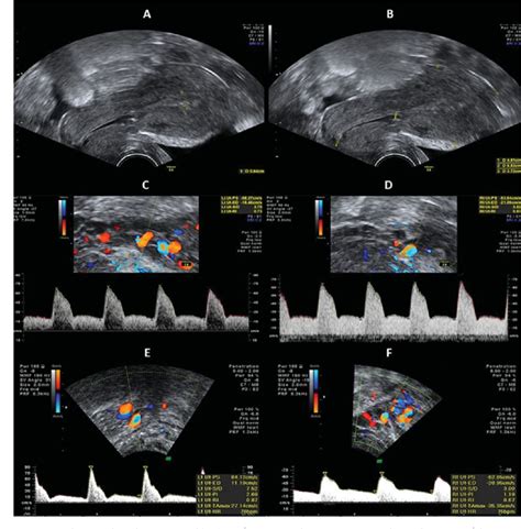 [pdf] Modified Pereira Suture As An Effective Option To Treat Postpartum Hemorrhage Due To