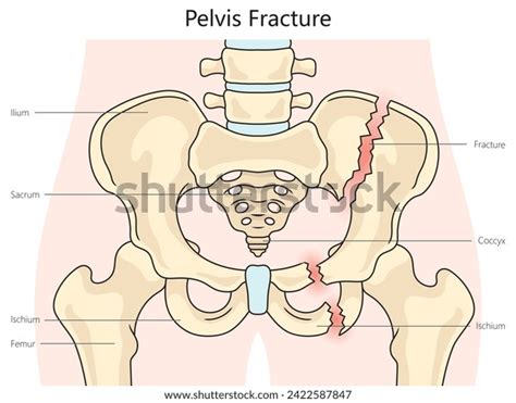 pelvic pelvis fracture structure diagram hand stock illustration