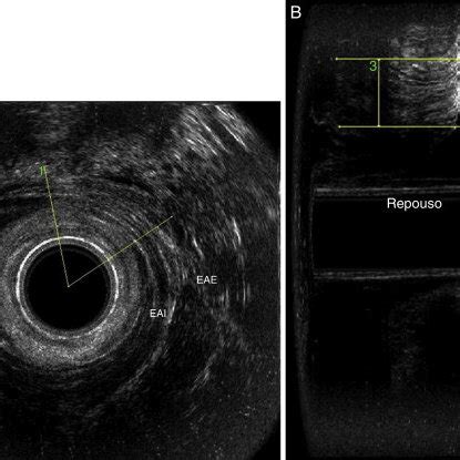 Female Patient With An Internal Anal Sphincter Ias Injury And Grade