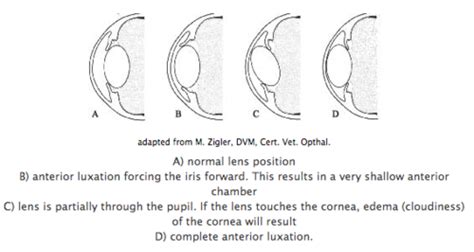 Lens luxation Flashcards | Quizlet
