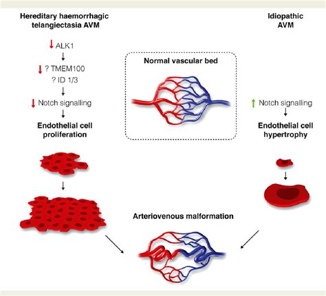 Figure 2 From Arteriovenous Malformations In Hereditary Haemorrhagic