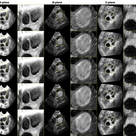 Results of the proposed method for gynecology test set. The first row ...