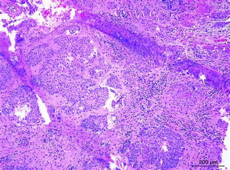 Histological Section Of A Moderately Differentiated Squamous Cell