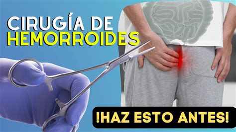 Lo Que DEBES Saber ANTES De La Cirugía De Hemorroides o Cirugía