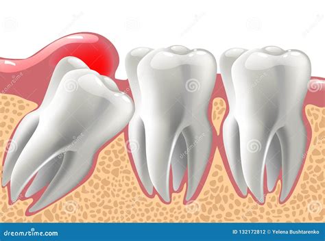 Wisdom Tooth Pushing Adjacent Teeth Wisdom Tooth Problem Teeth Row