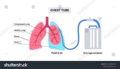 81 Lung puncture 图片库存照片和矢量图 Shutterstock