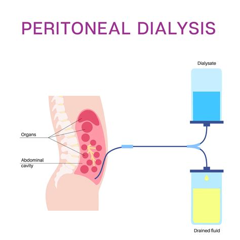 Dialysis Treatment Options - Renal Support Network