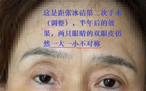 北京客来美舍 张冰洁医生 双眼皮修复两次术后效果（失败） 知乎