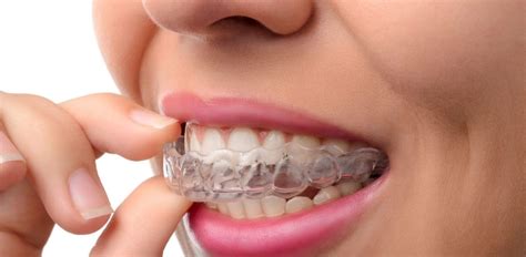 Transform Your Smile With Invisalign Fuller Dental