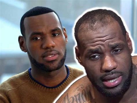 Lebron James Hair - Hair Transplant Analysis by Matt Dominance