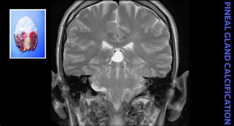 Pineal Gland Calcification • The Lowering of Human Consciousness